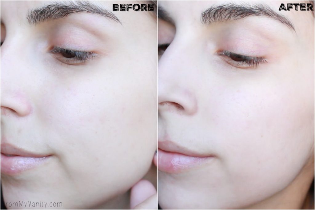 5 Benefits I Experienced from Using My PMD | Personal MicroDerm | Before/After Results | Left Side