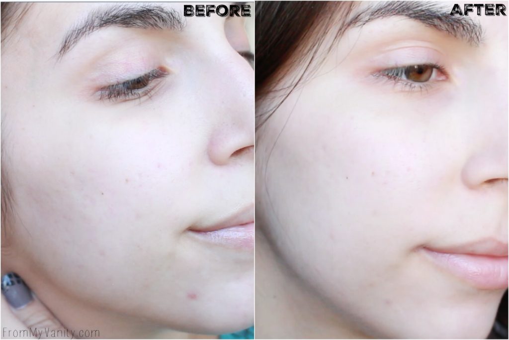 5 Benefits I Experienced from Using My PMD | Personal MicroDerm | Before/After Results | Right Side