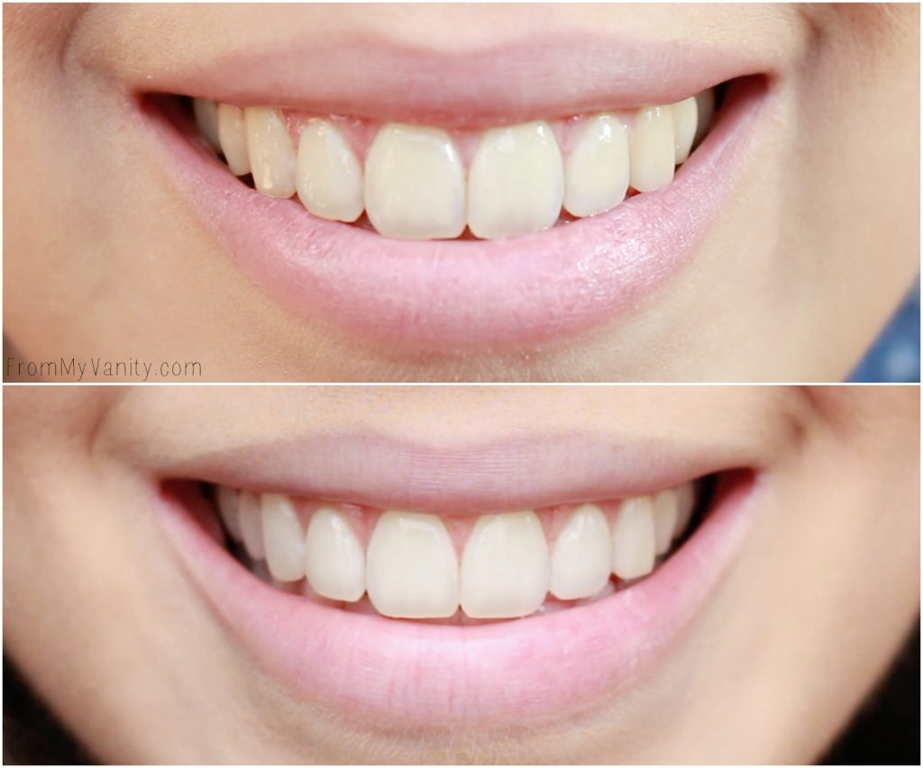 Achieving Whiter Teeth Naturally with Tom's of Maine | Before Using & After Just Two Weeks of Using!