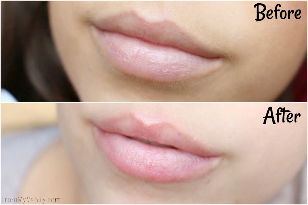 My Experience with the PMD Kiss Lip Plumping System | Before and After